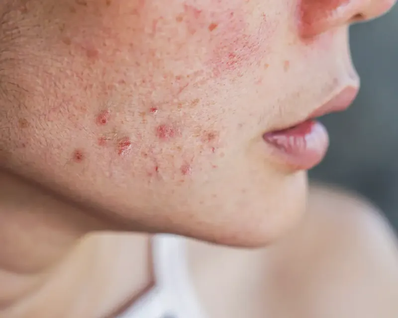 Dermatologie & Véneréologie Cergy Uniquement