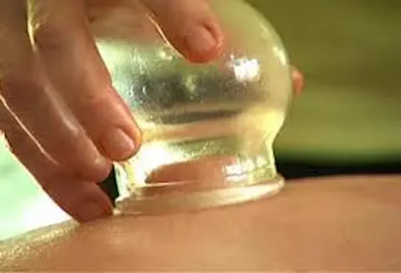 Photo de Acupuncture Traditionnelle