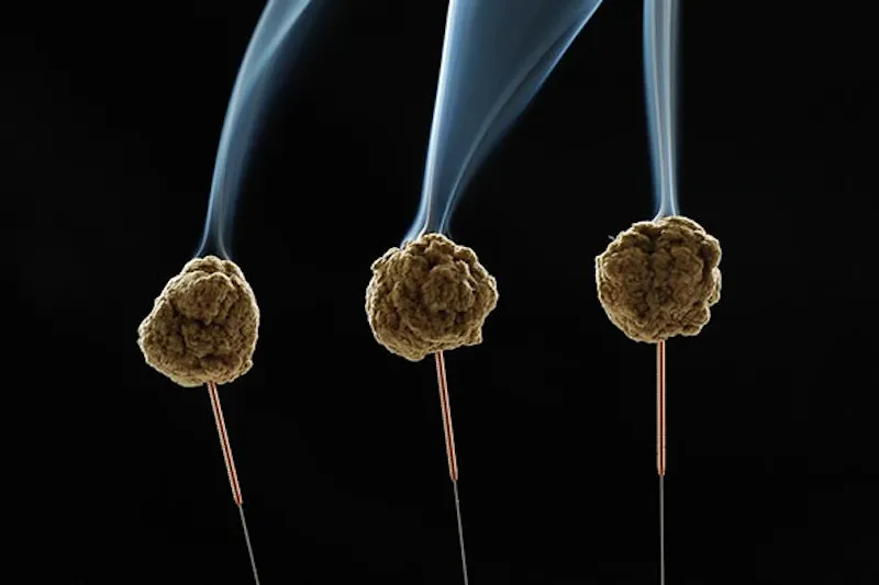 Photo de Acupuncture Traditionnelle